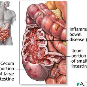 Ibs Eating Right - Irritable Bowel Syndrome - IBS